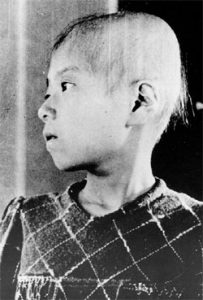 A Japanese girl who lost her hair from radiation sickness