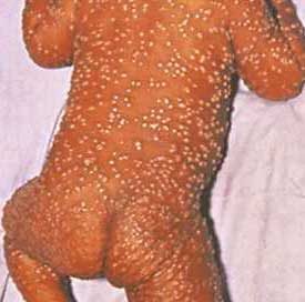 A baby with smallpox (from the CDC)