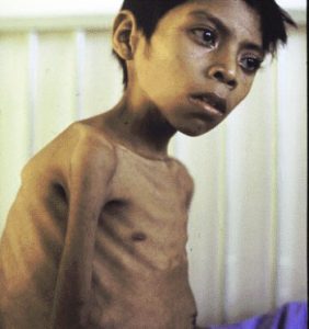 A brown-skinned boy with tuberculosis: a big chest, very skinny